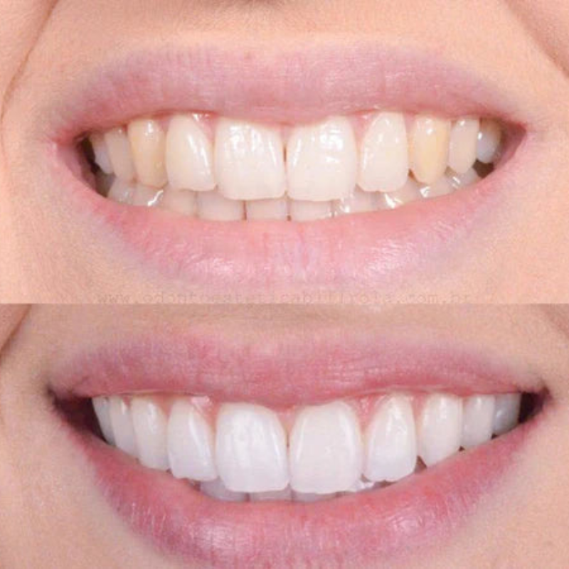 Quick teeth whitening for a dazzling smile