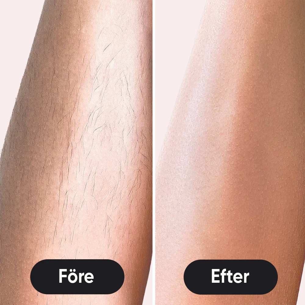 IPL - Permanent hair removal