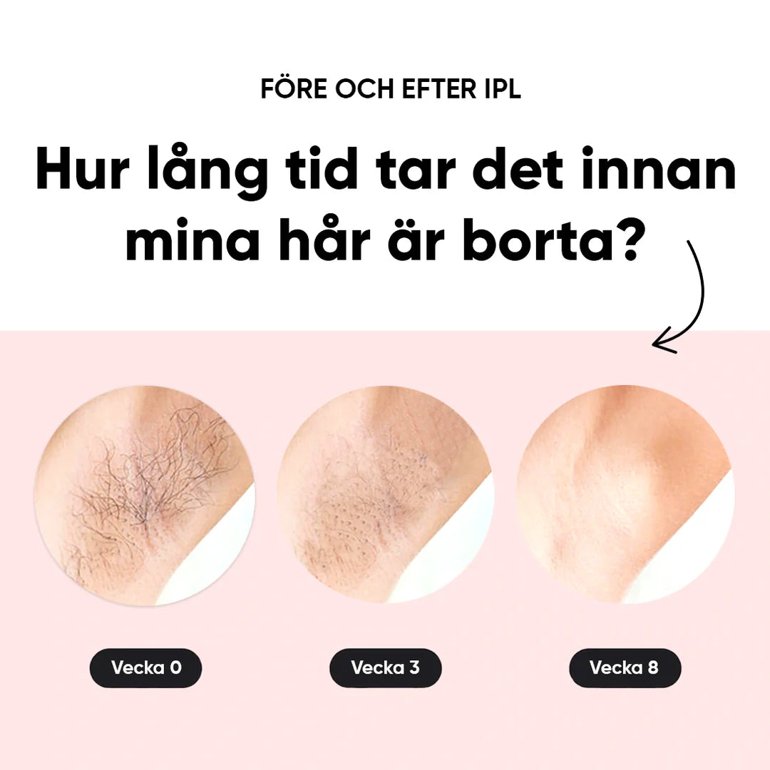 IPL - Permanent hårborttagning