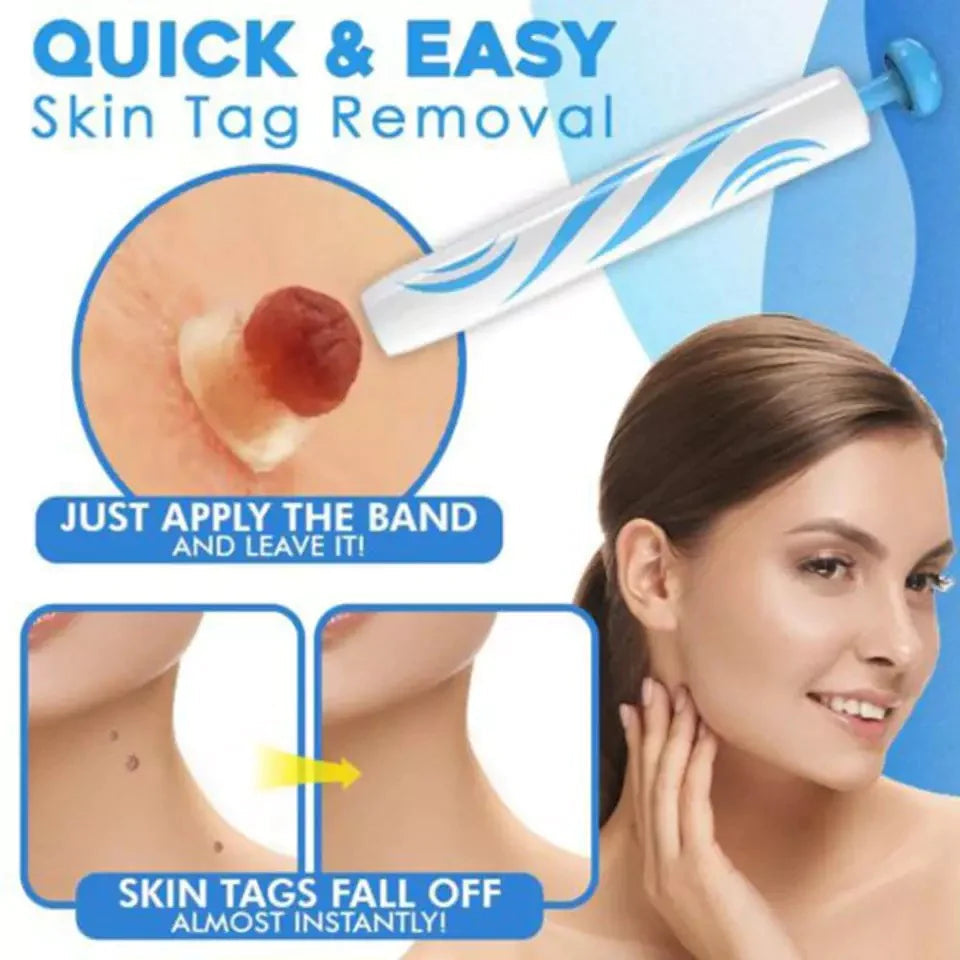 Auto tag removal kit - remove skin tags