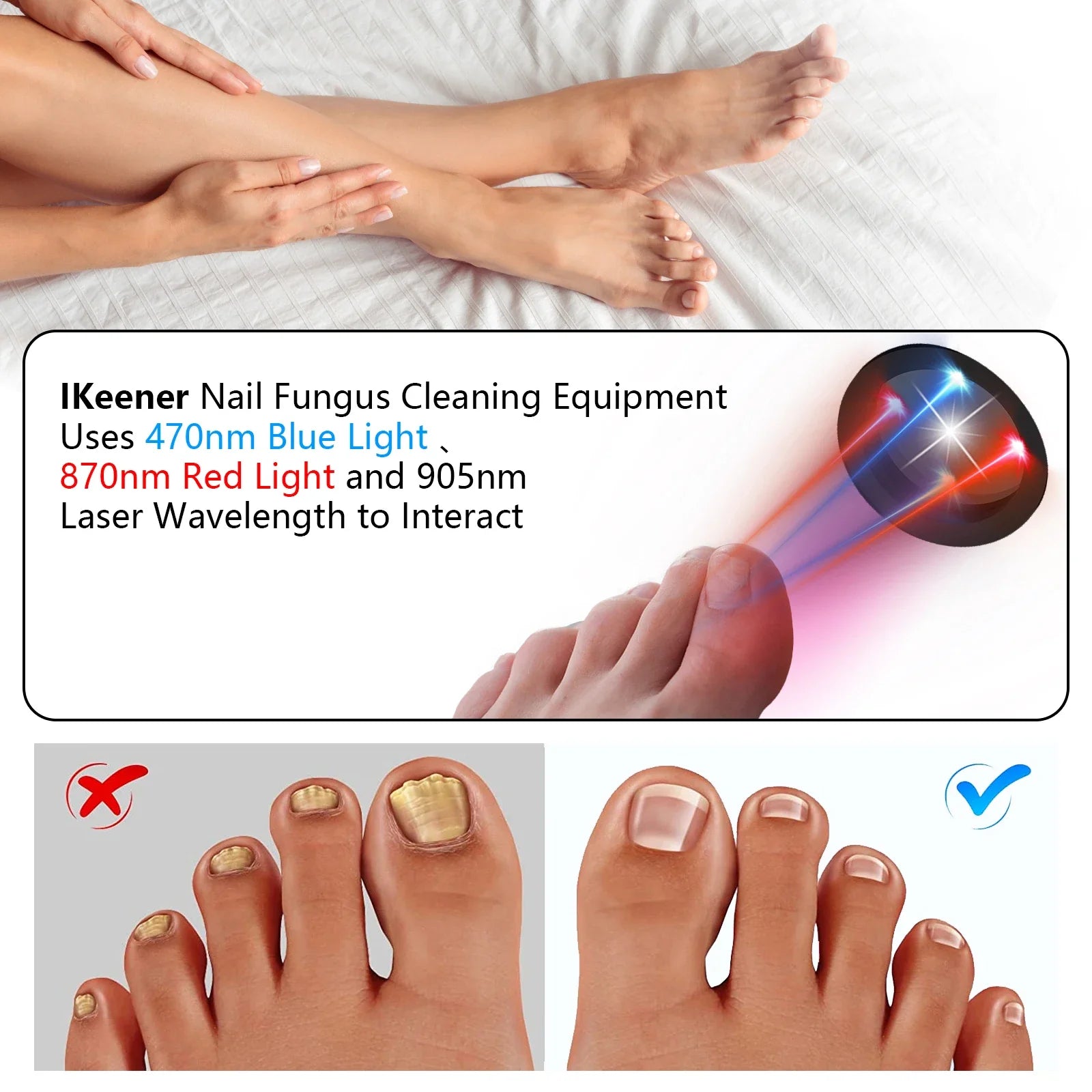 De antischimmel-lasertherapiemachine voor teennagels met USB-oplader