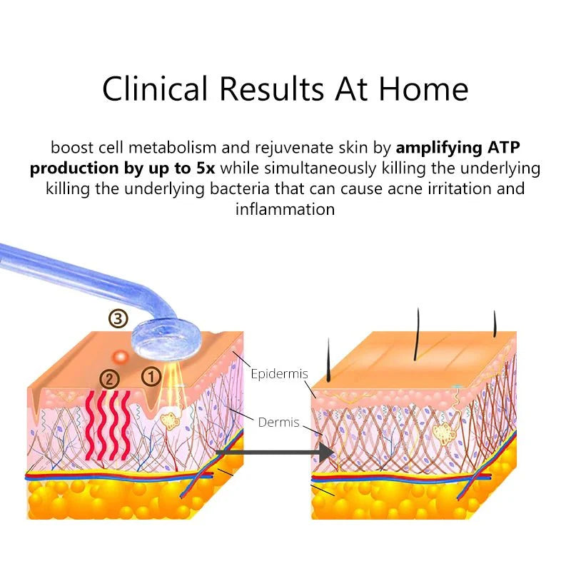 RedL Pro™ | Bacchetta ad alta frequenza contro l'acne