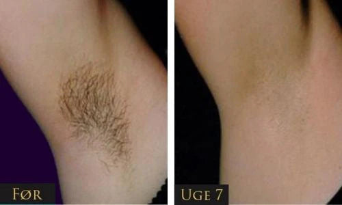 IPL - Permanent hair removal