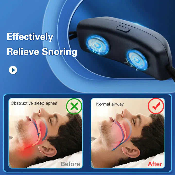 Smart Anti Snarkning Device EMS Puls Stop Snore Bärbar Bekväm Sov Bra Stoppa Snark Hälsovård Sömnapnéhjälp USB